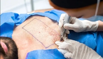 best hair transplant clinic in rajahmundry