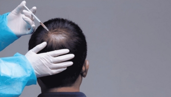 best hospital for hair loss treatment in hyderabad