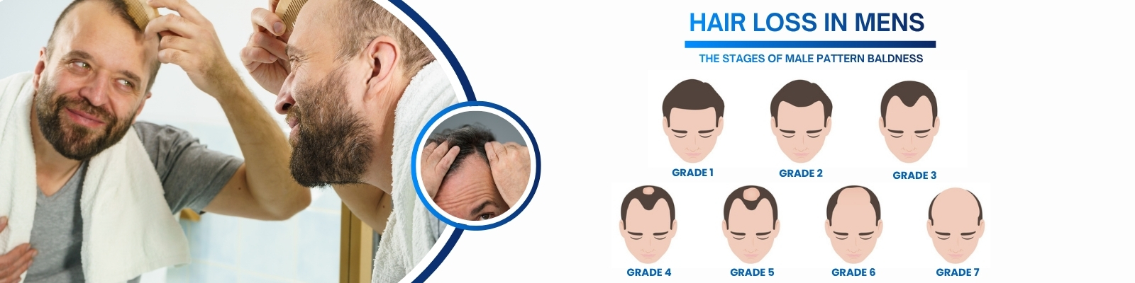 Hair Loss Treatment in Hyderabad