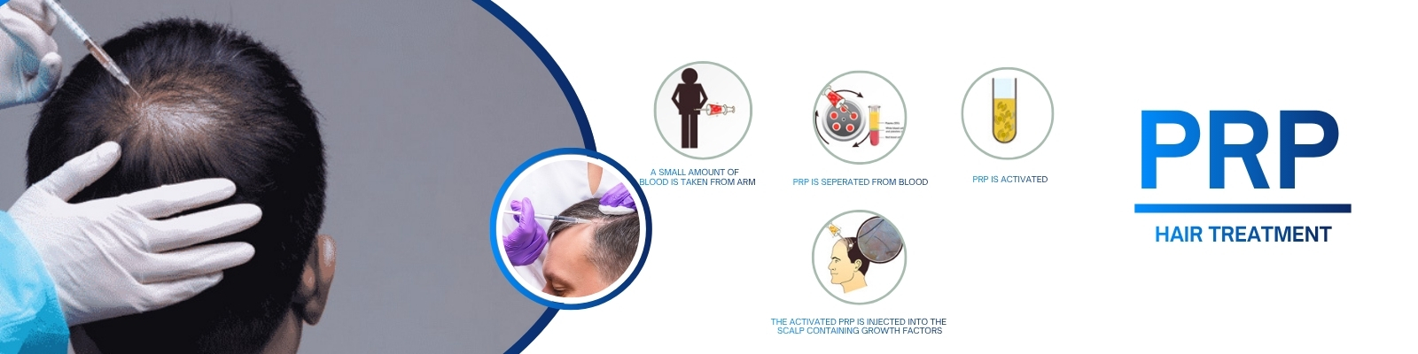 PRP Hair Loss Treatment in Hyderabad